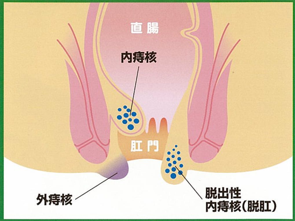 痔核（イボ痔）