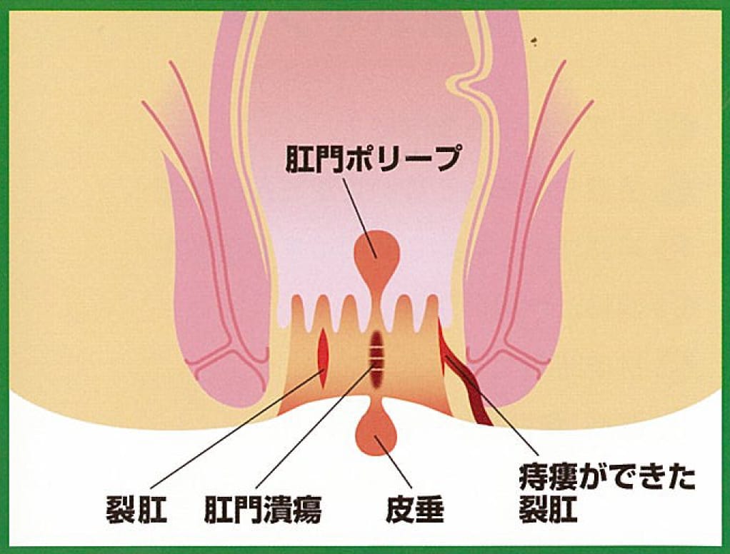 裂肛（キレ痔）